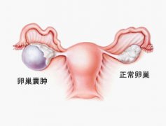 重庆市治疗卵巢囊肿多少钱呢