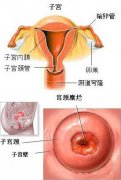 重庆宫颈糜烂手术治疗大概多少钱?