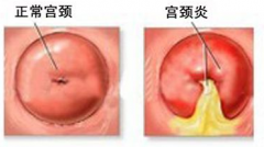 重庆宫颈炎的检查项目