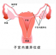 导致子宫内膜异位的原因有哪些?