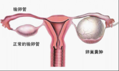 卵巢囊肿主要有哪些症状?