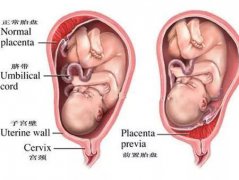 当胎盘前置妨碍“生命通道”，重庆安琪儿医院专家教孕妈应该注意些什么!