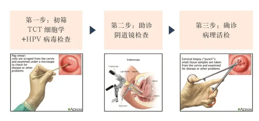 什么情况下需要宫颈活检？一文说清宫颈活检的意义