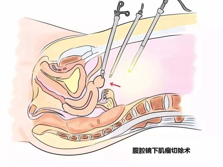 这些疾病不必非得开腹手术，腹腔镜也能“一招制胜”